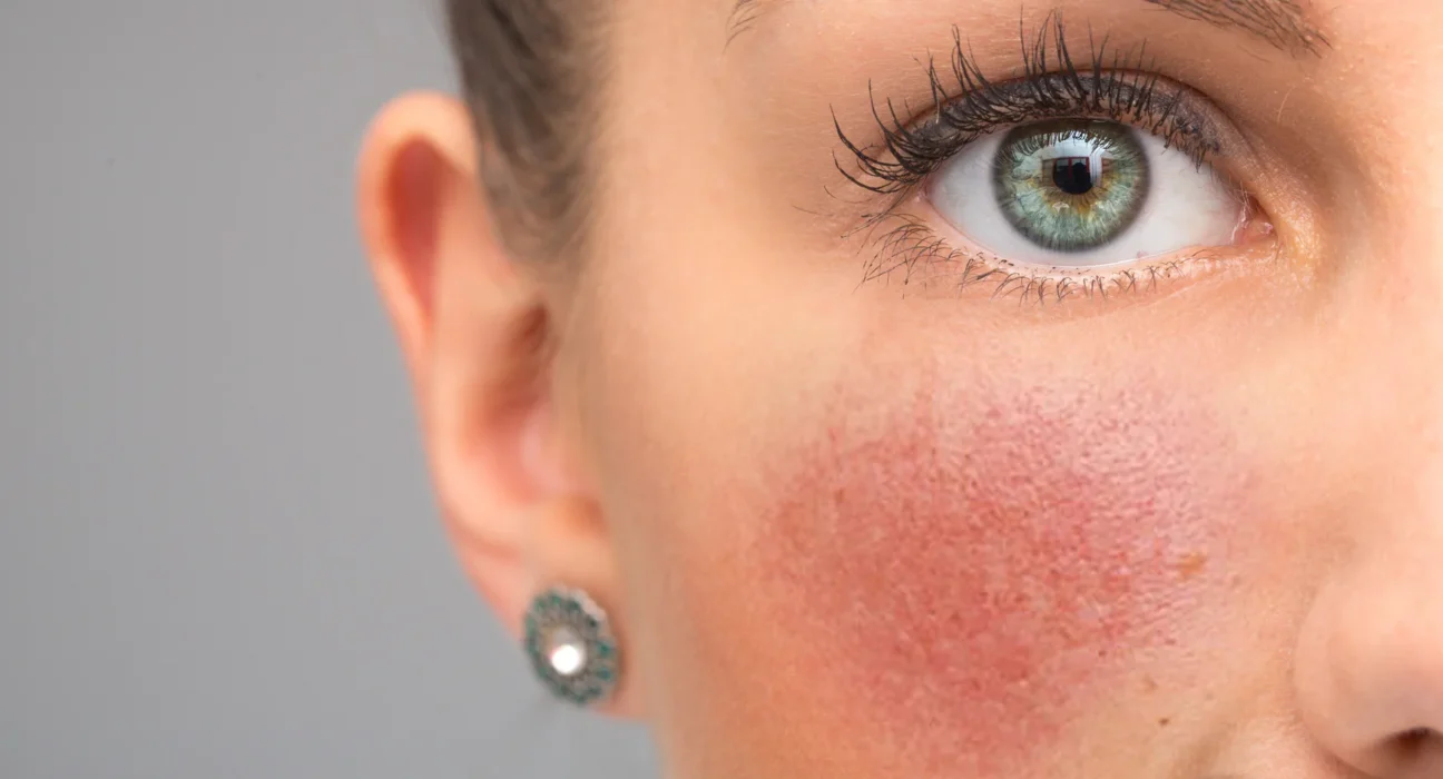 Alles over rosacea