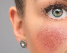 Alles over rosacea