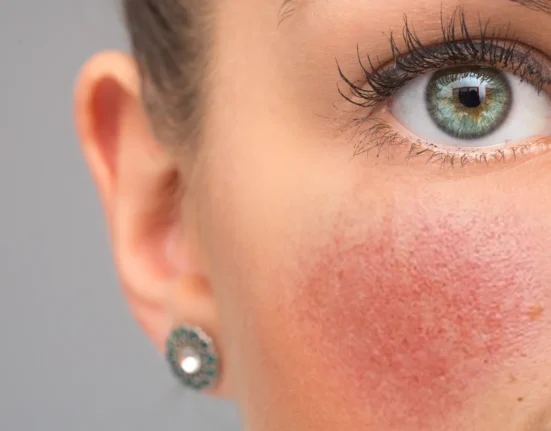 Alles over rosacea
