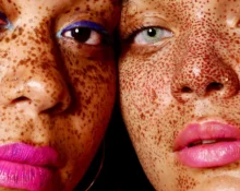 Melkzuur en Amandelzuur bij Pigmentatie