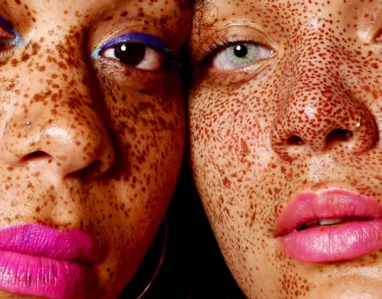 Melkzuur en Amandelzuur bij Pigmentatie