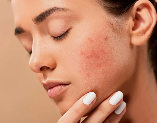 Acné aanpakken met zuren en enzymen